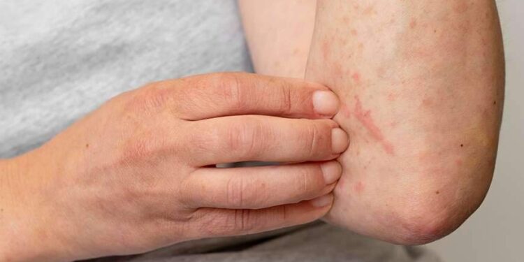 Alergia começa em casa: especialistas alertam para cuidados com o ambiente doméstico | Brasil