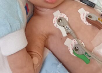 Bebê de 5 meses com síndrome de Down aguarda há 10 dias por leito de UTI em Belém