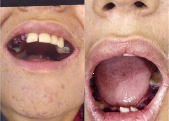 Adolescente com autismo ia fazer restauração e acaba com 17 dentes arrancados em Belém; 'erro médico', diz família | Pará