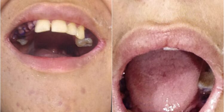 Adolescente com autismo ia fazer restauração e acaba com 17 dentes arrancados em Belém; 'erro médico', diz família | Pará