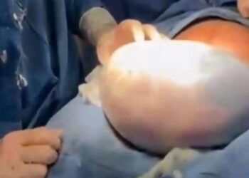 Em condição rara, bebê nasce empelicada em Goiás | Brasil