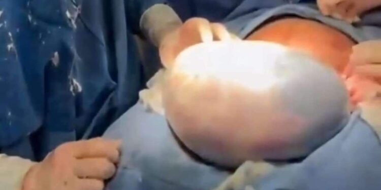 Em condição rara, bebê nasce empelicada em Goiás | Brasil